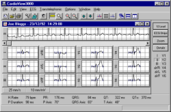 CardioView 3000 is a Windows based application that allows the collection, analysis, review , and printing of ECGs acquired from a Biolog 3000.